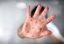 Michoacán se mantiene en alerta ante mpox