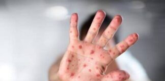 Michoacán se mantiene en alerta ante mpox