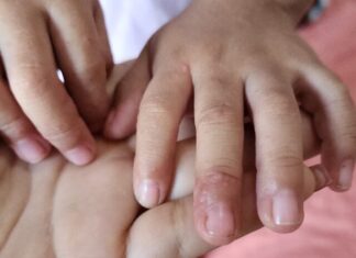 SSM descarta brote de virus de Coxsackie en la entidad